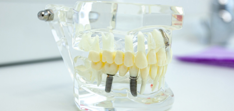 Dental Implants Somerset NJ | Restore Your Smile Today