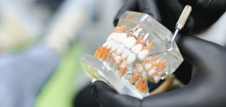 dental-implants-in-somerset Dental Implants Somerset NJ | Restore Your Smile Today