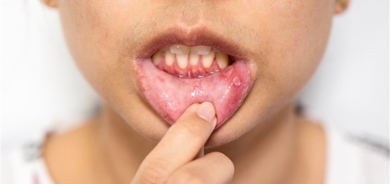 gum-disease-prevention Preventing Gum Disease