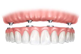 Smiledesigns-all-on-4-dental-implants