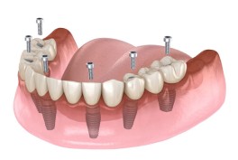 Smiledesigns-all-on-6-dental-implants