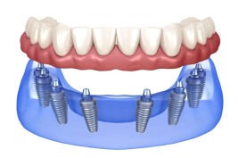 Smiledesigns-all-on-x-dental-implant