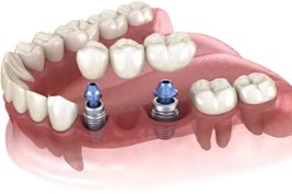 Smiledesigns-implant-supported-dentures